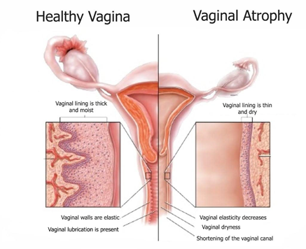 Vaginal dryness during period